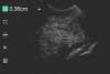Ultraschall