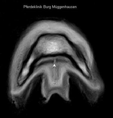 Lngsriss tiefe Beugesehne