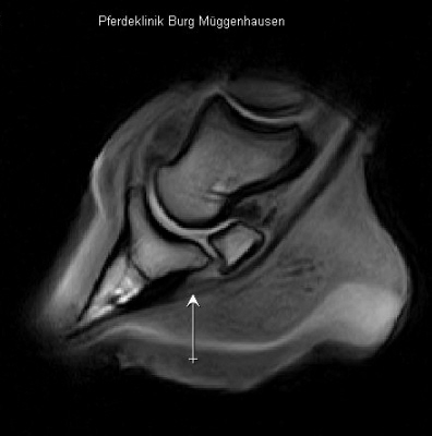 Lngsriss tiefe Beugesehne